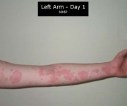 Guide to Urticaria Hives Here!