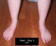 Urticaria Treatment: Dealing With The Itch