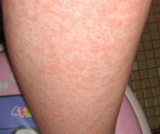 Looking for Urticaria Cure? Over Here!