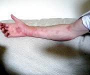 Looking For Hives Cure? Over Here!