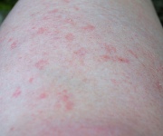 Chronic Hives: A Skin Disorder that Would Not Go Away
